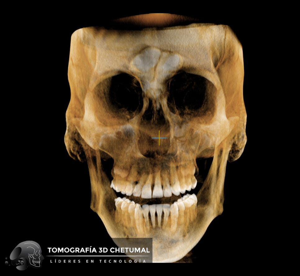 CT Cráneo Completo 21x19